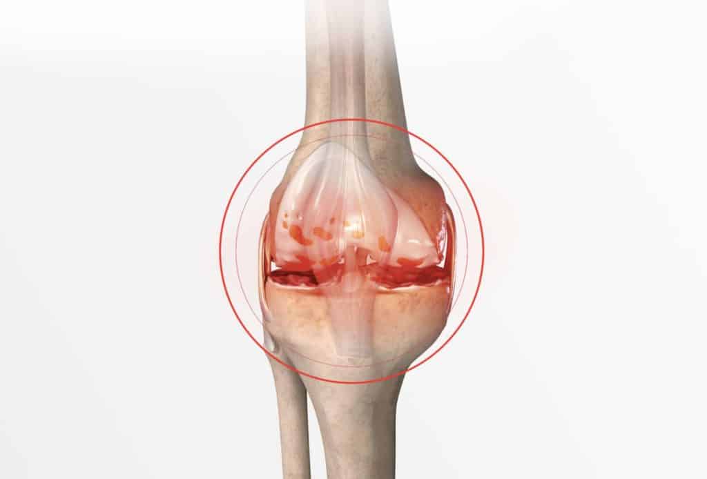 Arthrose : Réduire le stress, réduire la douleur