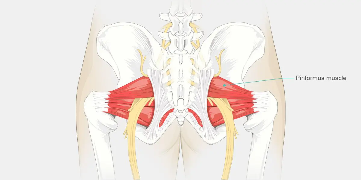 Qu'est-ce que le syndrome piriforme?